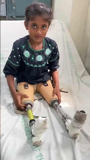 Above knee prosthesis fitting/ #hassanzarar#prosthetics #prosthesis #prosthetic-leg#artificiallimb