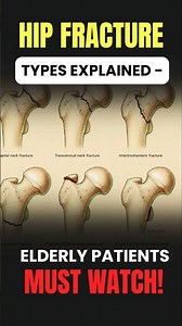 Hip Fracture Types Explained – Elderly Patients Must Watch | Dr. Amite Pankaj Aggarwal #shorts