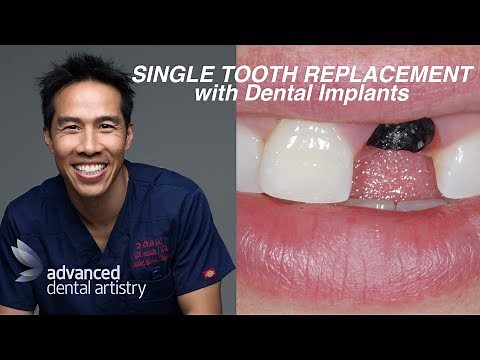 Single teeth implants