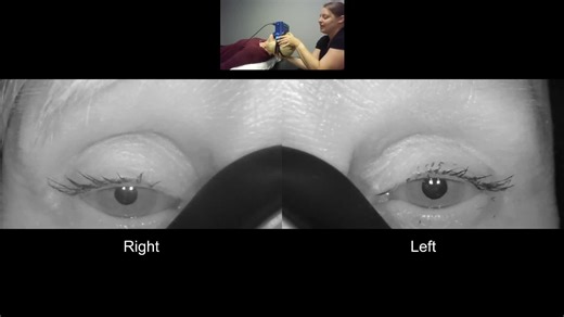Vestibular First on Instagram: "⬇️ Do you see the downbeat nystagmus? This was provoked with the straight head hang test (and I'd seen similar but more mild persistent downbeat in the left Dix-Hallpike test in the same patient). ⏰ Symptoms: mild off-feeling. Duration of nystagmus: persistent. It could be atypical BPPV or a central positional nystagmus (brain issue)! 🙃 I trialed a modified Yacovino, 10 minutes rest, then re-test of the straight head hang showed no nystagmus and no symptoms. 👂 L