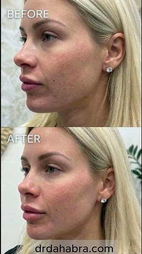 The Transformation: Dr. Dahabra's Cheek & Lip Filler Results! #shorts