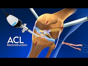 ACL Reconstruction 3d Animation Surgery | Hamstring Method Arthroscopic Acl reconstruction