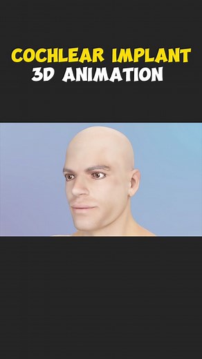 Cochlear Implant 3D Aniamtion #cochlearimplant #cochlearimplants #cochlearimplantkids #cochlearimplantactivation #earimplant #earsurgery #earsurgerycheck #hearingimpaired #soundprocessor #deaf #medical3danimation #3dmedicalanimation