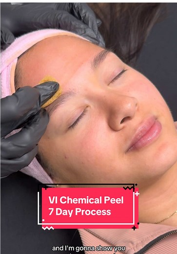 My 7 Day process of the VI Chemical peel with results. I completed this as a preventative treatment against aging and sun damage! I definitely struggled during this process so I recommend timing it where you have no plans for the week! Location: KC injectables @Brookelyn Fry #vipeel #chemicalpeel #facialtreatment #vipeelresults #skincare