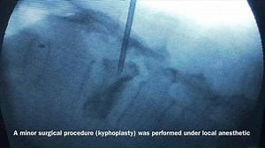 This 72 year old woman had a fall at her home and she sustained a fracture in her lumbar spine and was unable to walk. She was taken to a big renowned hospital locally, where she was advised to wear a jacket and a prolonged bed rest was suggested, which was inconvenient for her. Her daughter brought her to A.O Clinic to see foreign trained spinal surgeon Dr. Athar Muniruddin Siddiqui. Dr. Siddiqui after taking her other medical conditions (i.e. diabetes, high B.P etc) under consideration advised