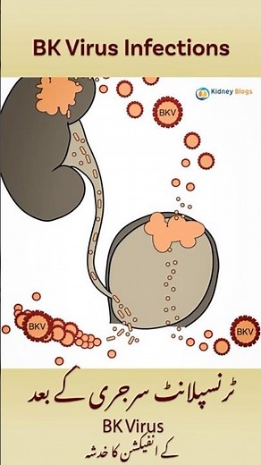 BK Virus infection in Kidney Transplant patients! #ckd #kidneydisease #kidneyhealth