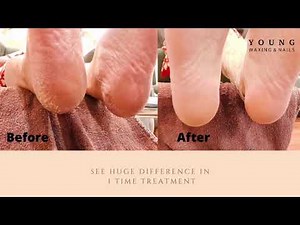 FOOTLOGIX Callus Treatment Tutorial