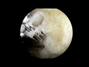 Arthroscopic Trapeziectomy With 4 mm Arthroscope and Without Traction Tower