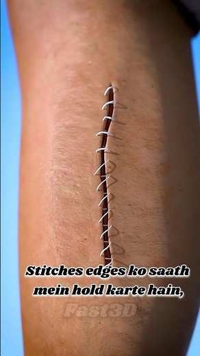 How Stitches Work? Wound Healing Process Explained Step-by-Step.||टांके लगने के बाद क्या होता है? 😱😱