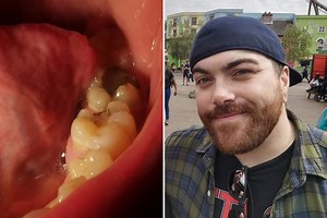 I found it so hard to see a dentist I ripped out bits of tooth with pliers