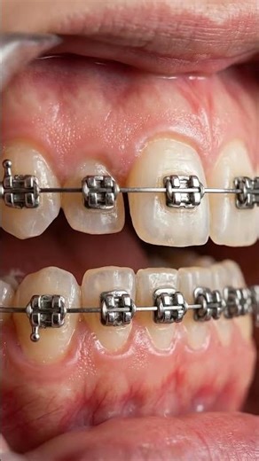 From Crooked Teeth to Perfect Smile 🦷 Amazing Orthodontic Transformation #CrookedTeeth