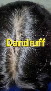How to get rid of Dandruff fast ✅️ #dandruff #dandrufftreatment #shorts #dandruffcontrol #viral