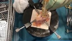 Femoral Condyle Osteochondral Allograft Transplantation
