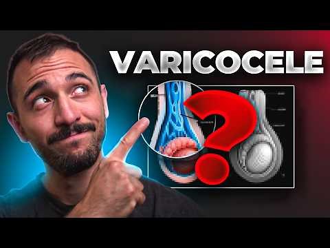 What is a varicocele and when is it operated on?