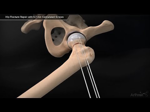 Hip Fracture Repair with 6.7 mm Cannulated Screws