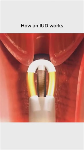 Medical Student on Instagram: "How an IUD Works.."