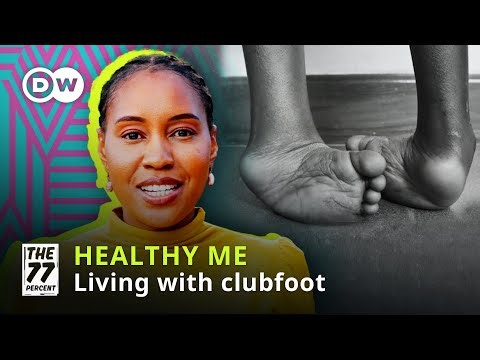 Walking tall: Life with clubfoot | Healthy Me, No Cap!