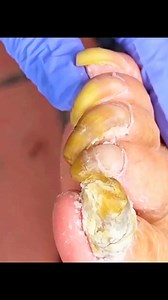 Pedicure the toenails clean | RoBi Bro's