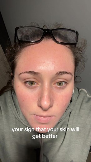 Dupixent: Transforming Eczema Management for Better Skin