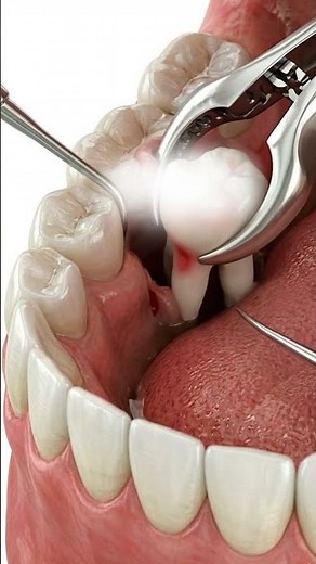Wisdom Tooth Extraction 🦷 | Satisfying 3D Procedure