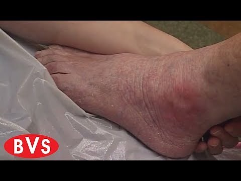 Pressure Ulcer Prevention - BVS Training