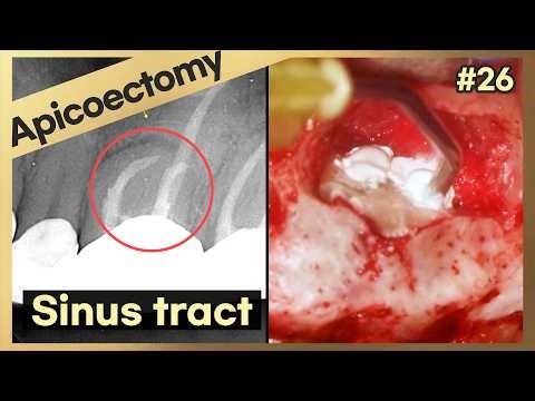[Online Surgery] Apicoectomy on #26 MB,DB (AI Voice-over)