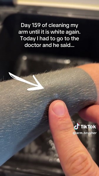 Cleaning My Arm: Day 159 of My Journey