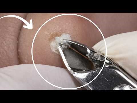 DEEP Foot Callus Removal 😱 | Real Podiatry Procedure (Very Satisfying)