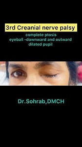 57K views · 705 reactions | 3rd Creanial nerve palsy | Dr-Sohrab Rustom | Facebook