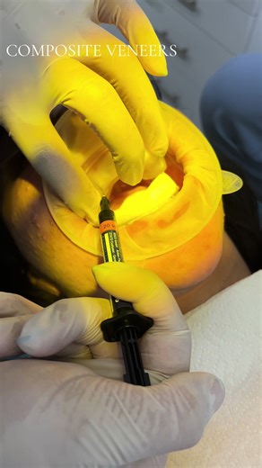 Want a brighter, natural smile in just on 2 appointments? #compositeveneers #veneers #tijuanadentist #smiletijuana #smilemakeover
