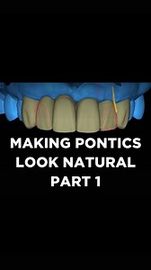 #LabReality case discussion of the week: Designing pontics - most commom mistakes and how to make a pontic look good. What do you think? | Christian Coachman