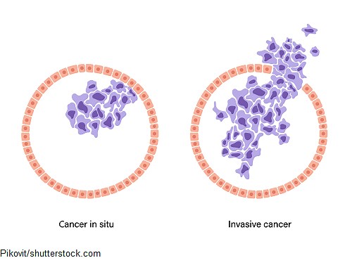 Cancer Classification Tumor Grading and Staging (TNM)