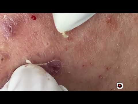 Big Cystic Acne Blackheads Extraction Blackheads & Milia, Whiteheads Removal Pimple Popping