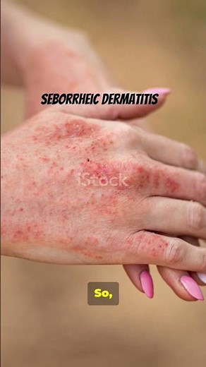 Seborrheic Dermatitis – Causes, Symptoms & Treatment | Dr. Bob’s Medical Insights