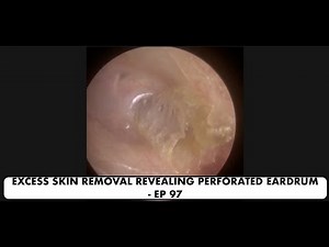 EXCESS SKIN REMOVAL REVEALING PERFORATED EARDRUM - EP 97