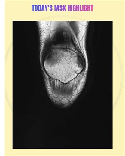 Today's MSK Highlight I Iliotibial Band Region