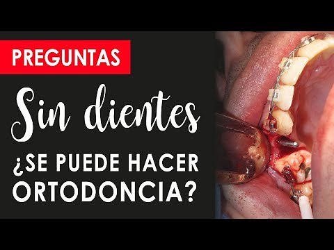 CAN I WEAR BRACES IF I'M MISSING TEETH? | Preprosthetic Orthodontics