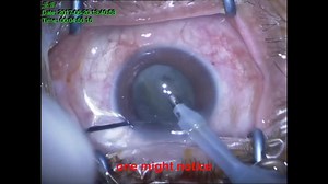 Cystotome-Assisted Prechop Technique - Eyetube