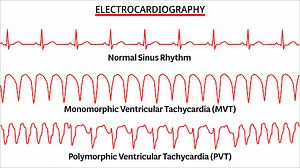 Set of ECG Common Abnormalities - Normal Sinus Rhythm - Monomorphic...