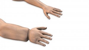 Edema Swollen Hand Arm Lymphedema Disease Stock Footage Video (100% Royalty-free) 3542588365 | Shutterstock