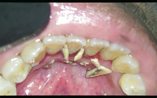 【4K超清】沉浸式洗牙 （一）