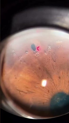 YAG Laser Iridotomy Procedure | Preventing Angle-Closure Glaucoma #doctor #eyehealth