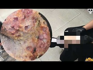 Extreme Jigger Infestation – Unexpected Deep Tissue Impact! #VP386