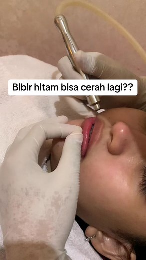 Lip Treatment for Dark and Dry Lips - Get Brighter Lips Today!