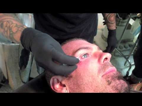 Rich Piana getting dermal implant removed