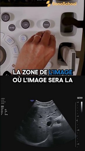 Optimiser la résolution : Le réglage de la focale en 2D – iSonic | iSonicSchool