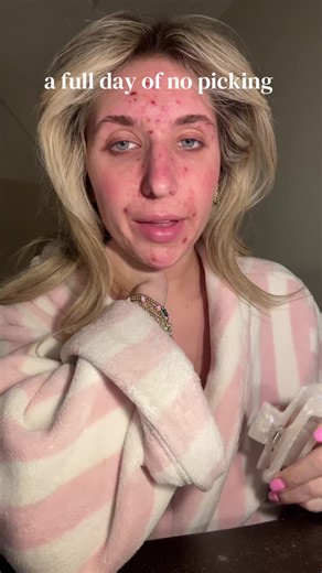 Hoping I can keep my hands off it this week #dermatillomania #skinpickingdisorder #ocd @Honeydew Labs @Briotech @PeaceOutSkincare