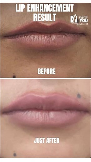 Lip Enhancement Procedure Before After Results | Lip Augmentation in Mumbai | Dr. PK Talwar