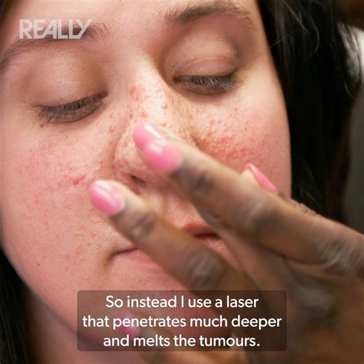 Lauren's having laser treatment for face lesions but will she be happy with the results? 🩺 #DrMercy | Really Channel