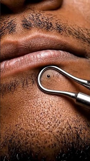 Hidden Lip Blackheads Finally Extracted